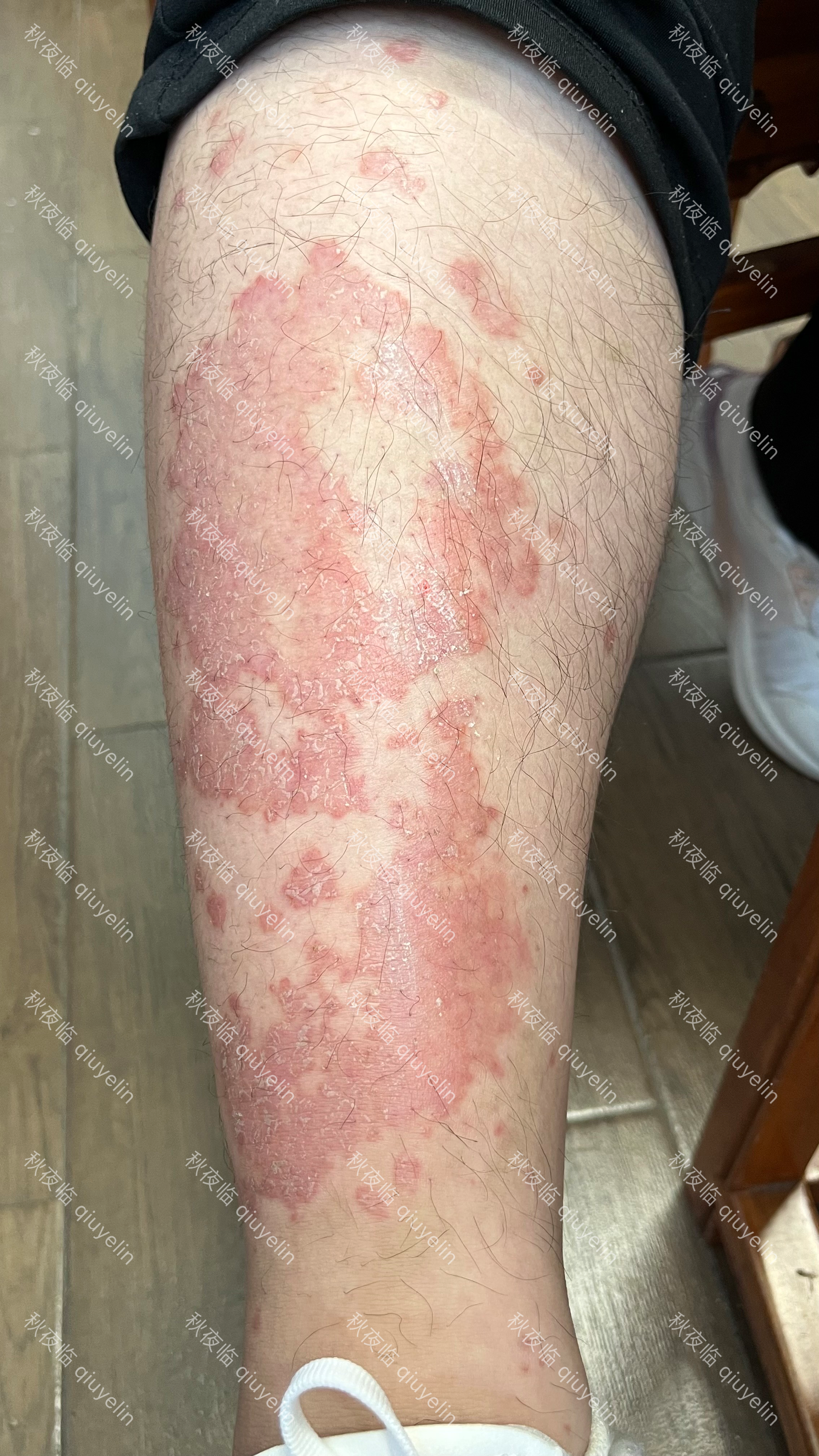 银屑病.PNG